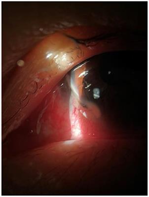 Case Report: Use of Amniotic Membrane for Tectonic Repair of Peripheral Ulcerative Keratitis With Corneal Perforation